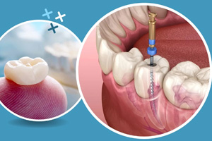 Root Canal
